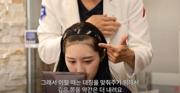 Important Design Points for Hairline Hair Transplantation in Transgender (Gender-Affirming) Patients image 5
