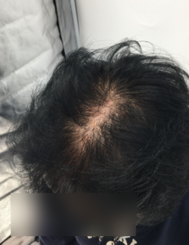 여성 탈모 주사, 의료진이 적극 권하는 2가지 이유? 관련 이미지 2