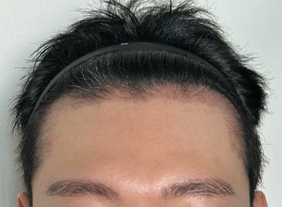 모발이식 부작용, 모두 같은 위험일까? 일시적 변화와 주의해야 할 신호 관련 이미지 3