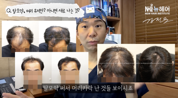 탈모약 효과, 탈모 유지? 머리카락이 새로 나는 경우도 있나요? l 두타스테리드 관련 이미지 8
