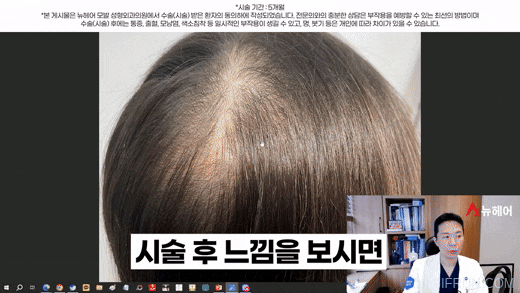 정수리탈모 가르마탈모 스트레스 때문에 두피문신했더니(두피문신 케이스리뷰) 관련 이미지 6