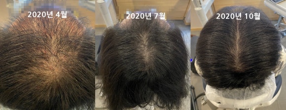 [탈모치료] 뉴헤어 탈모치료(모낭주사) 7개월 후기사진 관련 이미지 1