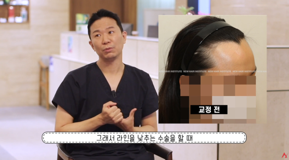 여성 V자 헤어라인 튀어나옴, 위도우스 피크 총정리 관련 이미지 4