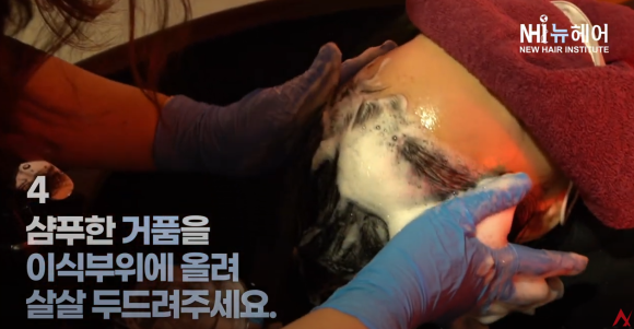 모발이식 후 샴푸(머리감기), 언제부터 가능? 안전하게 머리 감는 방법 관련 이미지 6