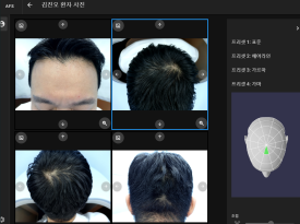 Why Hair Loss Diagnoses Differ by Clinic: What Are the Differences? image 4