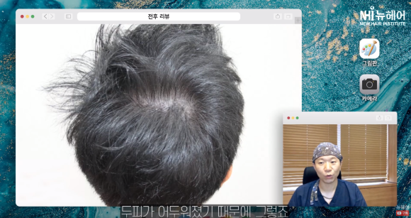두피문신 전 필독! 두피문신도 테스트가 가능하다? 관련 이미지 3