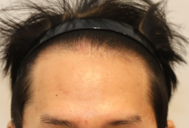 가족력탈모, 언제부터 살펴보는 게 좋을까? 관련 이미지 1