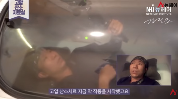 모발이식 후 고압산소치료, 생착률과 회복에 정말 도움이 될까? 관련 이미지 3