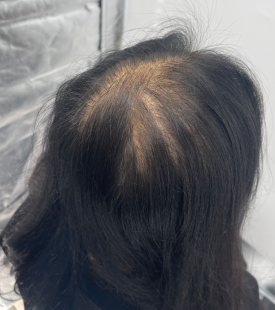 모발문신후기? 탈모치료와 병행한 40대 여성 환자분 사례 관련 이미지 3