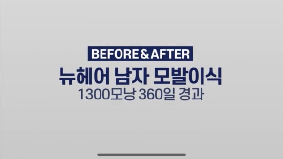 남자 앞머리 모발이식 l 탈모 모발이식 1년 전후 사진 관련 이미지 1