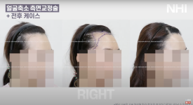 이마축소! 얼굴 작아지는 헤어라인교정 l 여자 모발이식 전후 사진 보기 관련 이미지 2