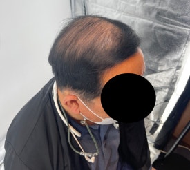 두피문신후기, 60대 남성 사례 전부 공개합니다 관련 이미지 5