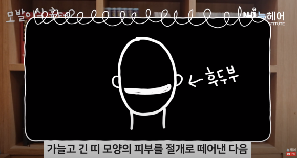 모발이식 흉터 정리 끝! 비절개 & 절개 흉터 비교 관련 이미지 7