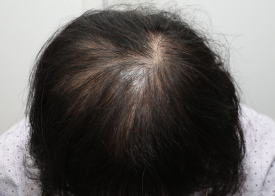 Why Are Crown Hair Transplants (Part-Line Hair Transplants) Slower to Show Results Than Other Areas? image 3