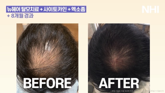 뉴헤어 탈모치료(모낭주사) 8개월 경과 사진 l 정수리탈모 관련 이미지 2