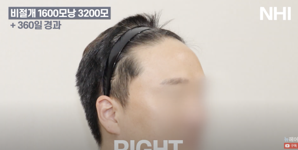 넓은 이마 탈모 모발이식 후기 l 전/후 사진 보기 1600모낭 l 뉴헤어 관련 이미지 4