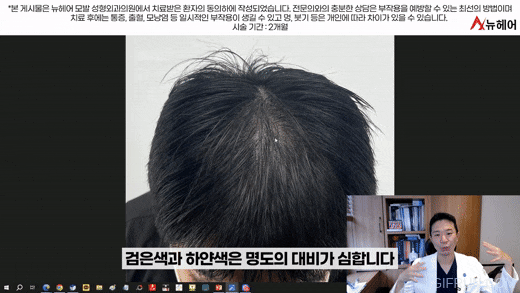 머리숱이 많아보이는 두피문신! 실제사례후기로 보는 비포&애프터 관련 이미지 8
