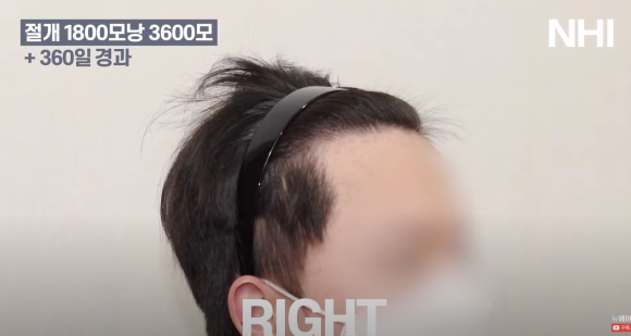 [뉴헤어] 모발이식 1800모낭(3600모) 1년 경과 사진 관련 이미지 5