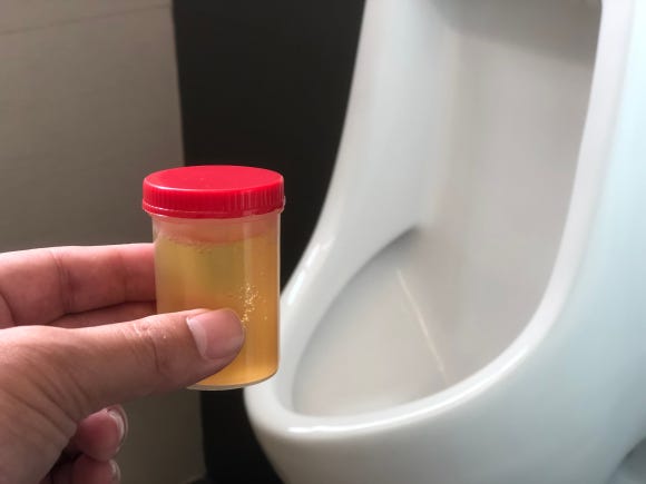 A Lot of Foam in My Urine: Proteinuria Symptoms (Pregnancy, Diabetes, Causes) image 2