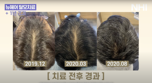 모발이식+탈모치료 관리 후기 + 사진포함 관련 이미지 2