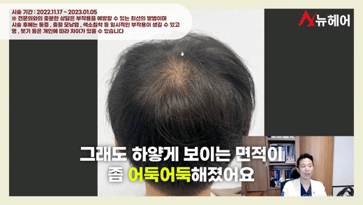 정수리두피문신 리얼 후기! 두피문신은 이런분들에게 추천합니다. 관련 이미지 6