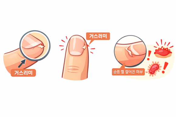 Why You Shouldn’t Pull Off Hangnails image 2