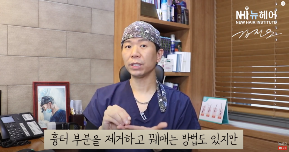 머리에 땜빵, 모발이식으로 채울 수 있을까? 관련 이미지 3