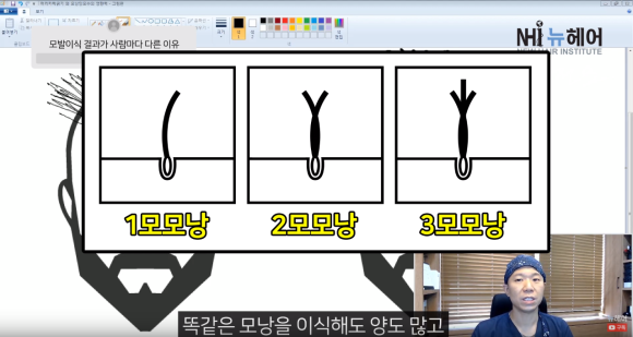 모발이식 결과가 사람마다 다른 이유  ㅣ모발이식 결과  l 모발이식 실패 관련 이미지 3