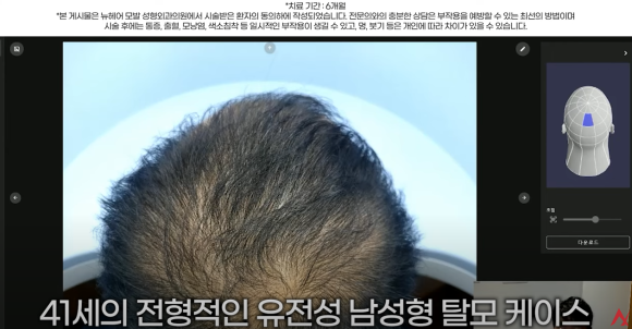 남성 정수리 탈모 치료 수술없이 주사만으로?(탈모약+주사치료) 관련 이미지 2