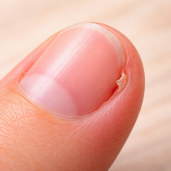 Why You Shouldn’t Pull Off Hangnails image 3