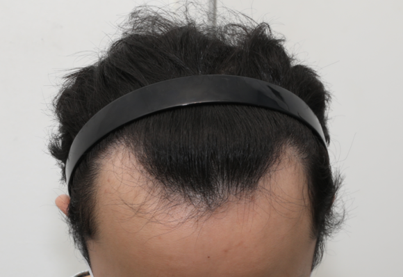 연령대별 탈모특징, 탈모 변화 과정은 어떨까? 관련 이미지 1