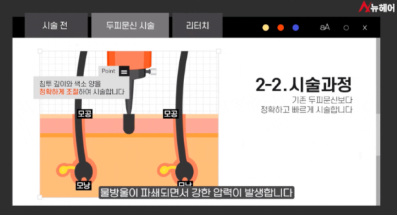 두피문신 QnA, 많이주신 질문 5가지 정리합니다 관련 이미지 6