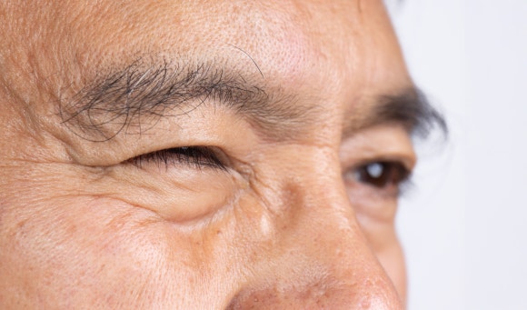 눈꺼풀 뾰루지 하얀 알갱이, 안검염 증상일수도? 관련 이미지 3