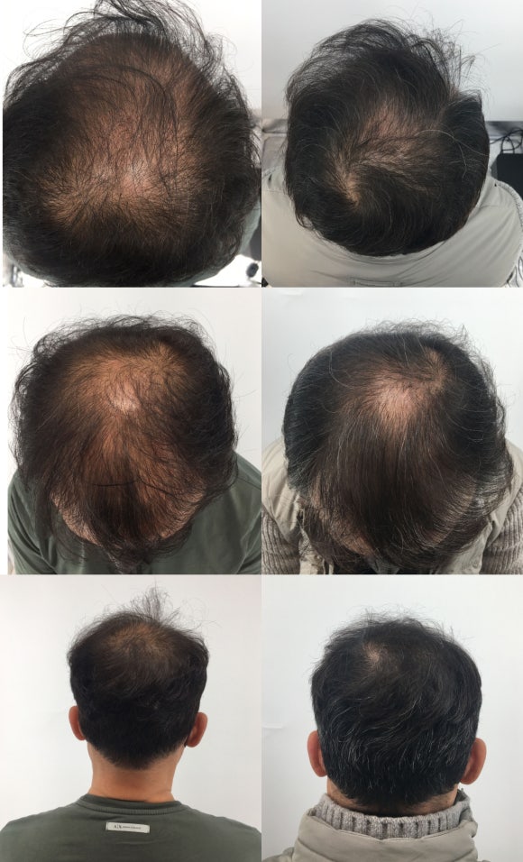남성탈모치료 6개월 받은 50대 남성 후기 관련 이미지 4