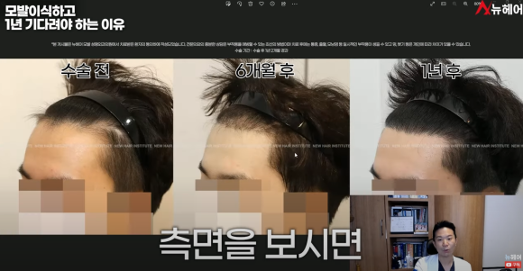 모발이식경과 1년을 기다려야 하는 이유 관련 이미지 12