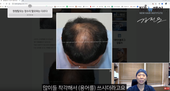 정수리 탈모 &ne; 원형 탈모 l  탈모 유형 구분법 관련 이미지 2