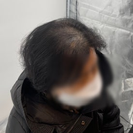 여성두피문신? 60대 실제 사례 사진으로 확인하세요 관련 이미지 16