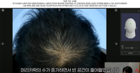 남성 정수리 탈모 치료 수술없이 주사만으로?(탈모약+주사치료) 관련 이미지 4