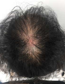 탈모모낭주사, 4달 치료받고 자신감 되찾은 50대 여성 사례 관련 이미지 4