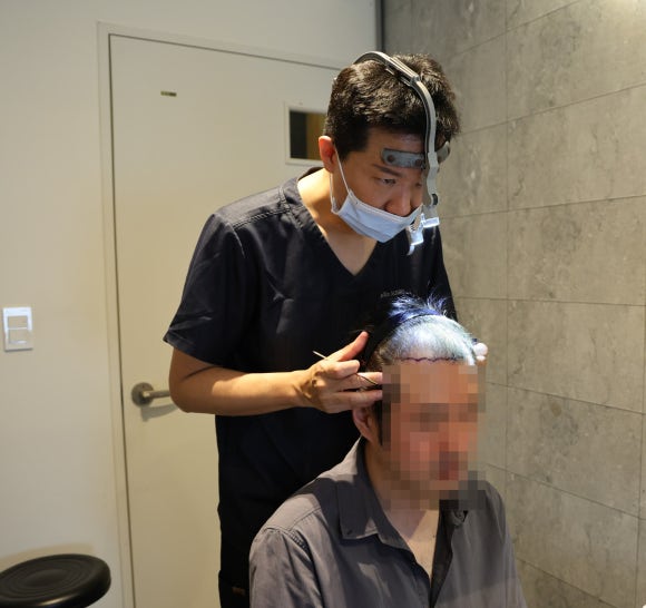 20대 M자 탈모, 약부터 먹어야 할까요? 원형탈모와 구별부터 모발이식 관련 이미지 2