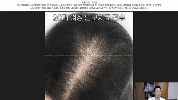 여자정수리탈모, 약 없이 치료하는 법 관련 이미지 6