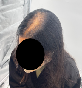 SMP후기, 두피문신 받고 자신감 회복한 30대 여성분 사례 관련 이미지 4