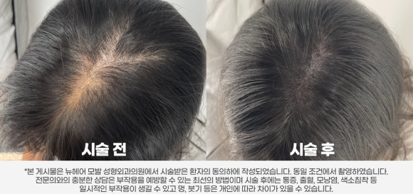 두피문신(SMP), 탈모 고민 완화를 돕는 새로운 방법? 관련 이미지 2