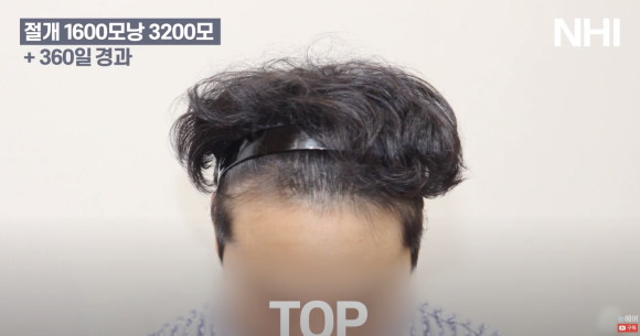 남자 모발이식 1600모낭 1년 지난 후 사진 경과 후기 관련 이미지 6