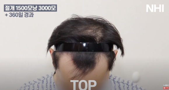 [뉴헤어] 모발이식 1500모낭 1년 후 사진 공개 l M자 엠자 남성탈모 관련 이미지 5