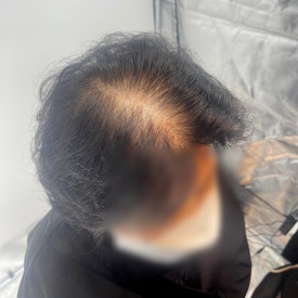 여성두피문신? 60대 실제 사례 사진으로 확인하세요 관련 이미지 2