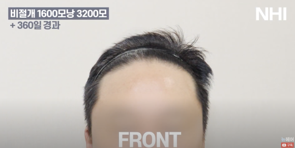 넓은 이마 탈모 모발이식 후기 l 전/후 사진 보기 1600모낭 l 뉴헤어 관련 이미지 2