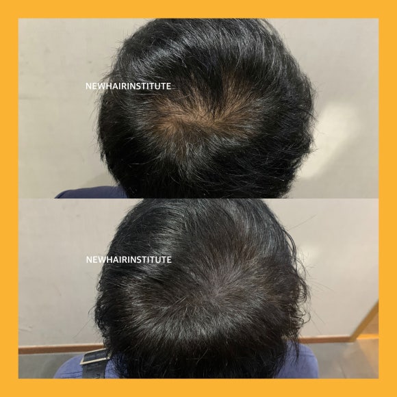 정수리, 가르마 두피문신 전후 사진 모음 ㅣ 뉴헤어 관련 이미지 3