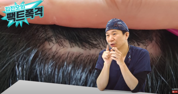 모발이식 채취 부위에는 모발이 자라지 않나요? 관련 이미지 2