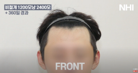 비절개 모발이식 헤어라인 엠자채우기 l 남자 탈모 모발이식 2400모 전후 사진 후기 관련 이미지 1